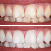 Fontainavie 3 in 1 teeth whitening foam